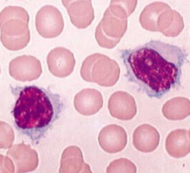 CD79a positivity (Courtesy Dr. V. Penopoulos)