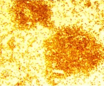 CD79a positivity (Courtesy Dr. V. Penopoulos)