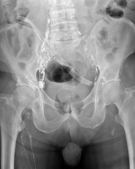 Lymphangiography without demonstration of a leak site (Courtesy Dr. V. Penopoulos)