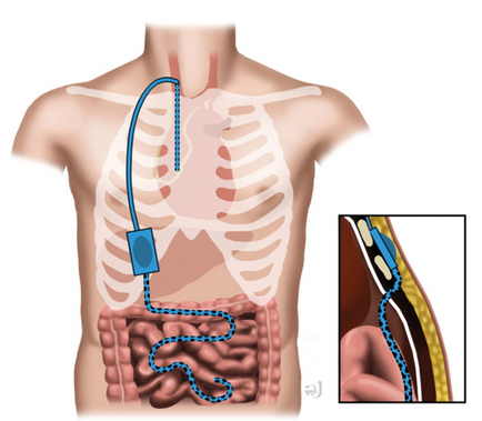 Peritoneovenous shunt in another patient with decompensated hepatic cirrhosis (Courtesy Dr. V. Penopoulos)