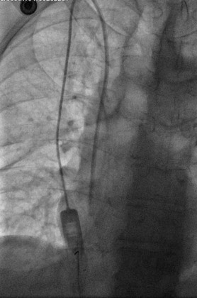 Peritoneovenous shunt in another patient with decompensated hepatic cirrhosis (Courtesy Dr. V. Penopoulos)