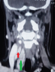 Green arrow — Right common carotid artery. Blue arrow — Right internal jugular vein. Purple arrow — Parathyroid adenoma. Yellow arrow — Right vagus nerve. Brown arrow — Trachea. Light brown arrow — Right recurrent laryngeal nerve (Courtesy Dr. V. Penopoulos)