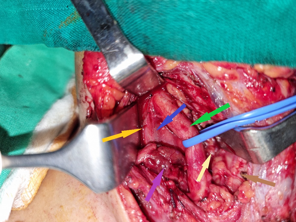 Green arrow — Right common carotid artery. Blue arrow — Right internal jugular vein. Purple arrow — Parathyroid adenoma. Yellow arrow — Right vagus nerve. Brown arrow — Trachea. Light brown arrow — Right recurrent laryngeal nerve (Courtesy Dr. V. Penopoulos)