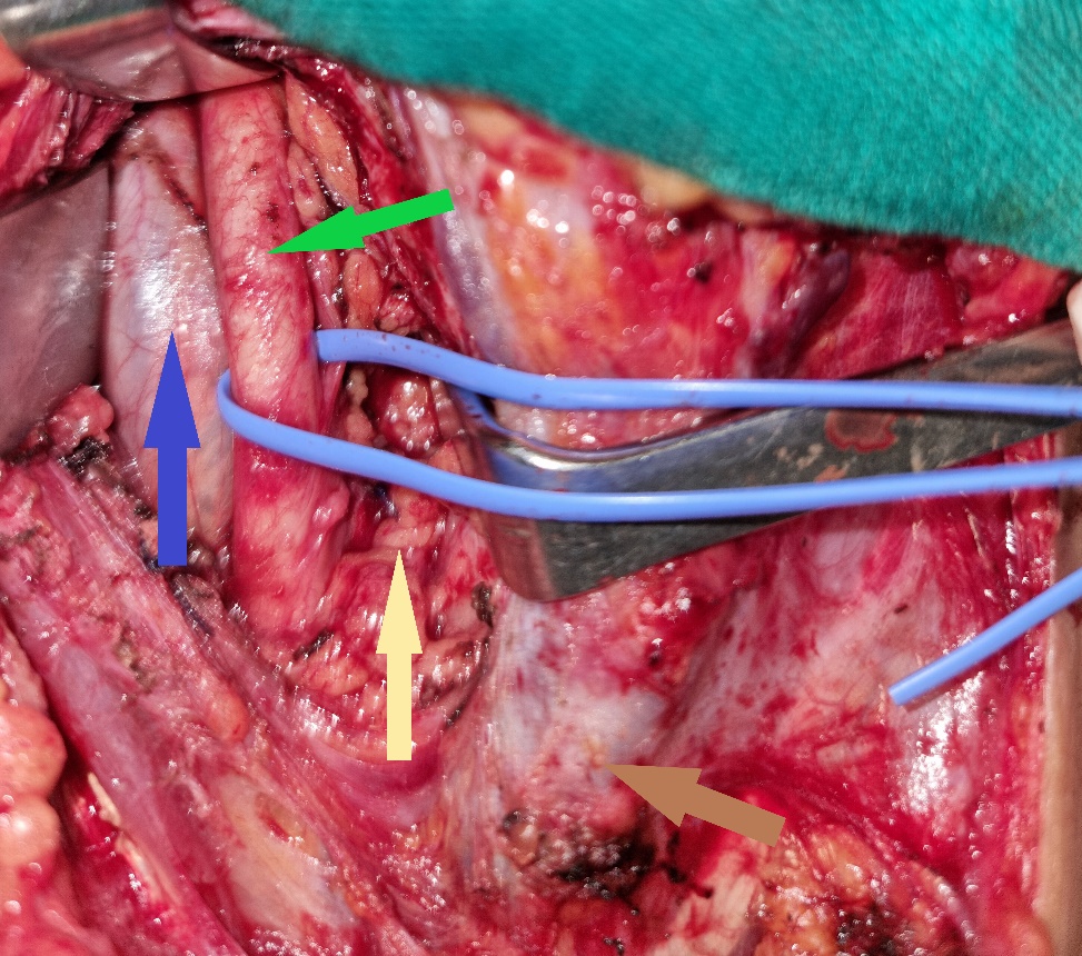 Encapsulated mass. Parathyroid adenoma (Courtesy Dr. V. Penopoulos)