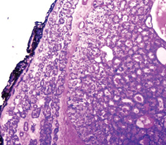 Encapsulated mass. Parathyroid adenoma (Courtesy Dr. V. Penopoulos)