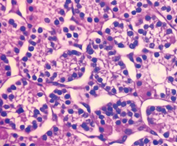Parathyroid adenoma. The cells demonstrate moderate pleomorphism, with centrally located round nuclei and clear/eosinophilic cytoplasm, without cellular atypia or mitotic activity (Courtesy Dr. V. Penopoulos)