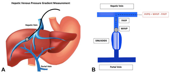 Spleno-renal shunt surgical approach (Courtesy Dr. V. Penopoulos)