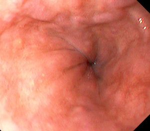 Spleno-renal shunt surgical approach (Courtesy Dr. V. Penopoulos)