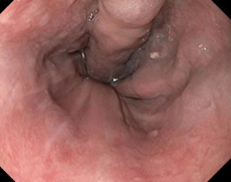 Spleno-renal shunt surgical approach (Courtesy Dr. V. Penopoulos)