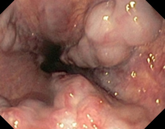 Spleno-renal shunt surgical approach (Courtesy Dr. V. Penopoulos)