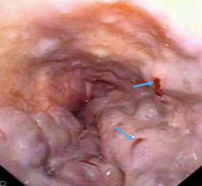 Spleno-renal shunt surgical approach (Courtesy Dr. V. Penopoulos)