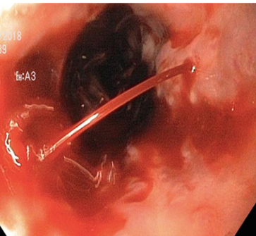 Spleno-renal shunt surgical approach (Courtesy Dr. V. Penopoulos)