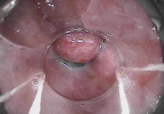 Spleno-renal shunt surgical approach (Courtesy Dr. V. Penopoulos)