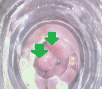 Spleno-renal shunt surgical approach (Courtesy Dr. V. Penopoulos)