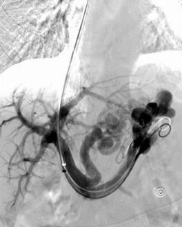 Spleno-renal shunt surgical approach (Courtesy Dr. V. Penopoulos)
