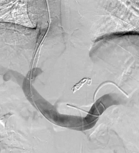 Spleno-renal shunt surgical approach (Courtesy Dr. V. Penopoulos)