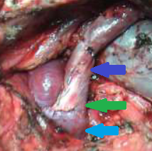 Spleno-renal shunt surgical approach (Courtesy Dr. V. Penopoulos)