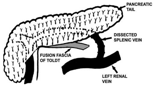 Spleno-renal shunt surgical approach (Courtesy Dr. V. Penopoulos)
