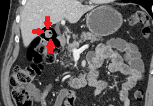 Red arrows — Presence of air within the gallbladder (Courtesy Dr. V. Penopoulos)