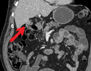 Red arrow — Inflammatory reaction between the hepatic flexure and gallbladder. Green arrow — Gallbladder. Yellow arrow — Right colon (Courtesy Dr. V. Penopoulos)