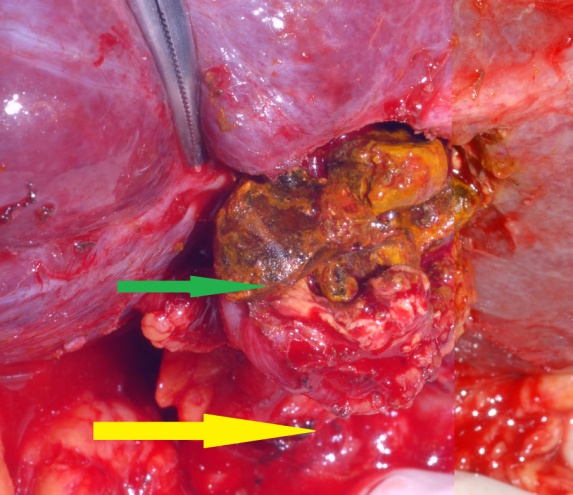 Subtotal cholecystectomy specimen (Courtesy Dr. V. Penopoulos)