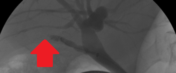 Subtotal cholecystectomy specimen (Courtesy Dr. V. Penopoulos)