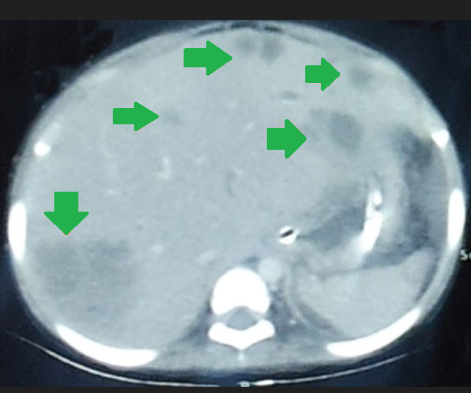 Multiple hepatic abscesses in other patients with cholecystocolic fistulas (Courtesy Dr. V. Penopoulos)