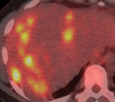 Multiple hepatic abscesses in other patients with cholecystocolic fistulas (Courtesy Dr. V. Penopoulos)