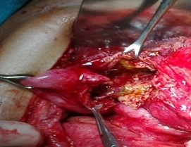 Hepatic abscess in a patient with cholecystocolic fistula and gallbladder empyema (Courtesy Dr. V. Penopoulos)