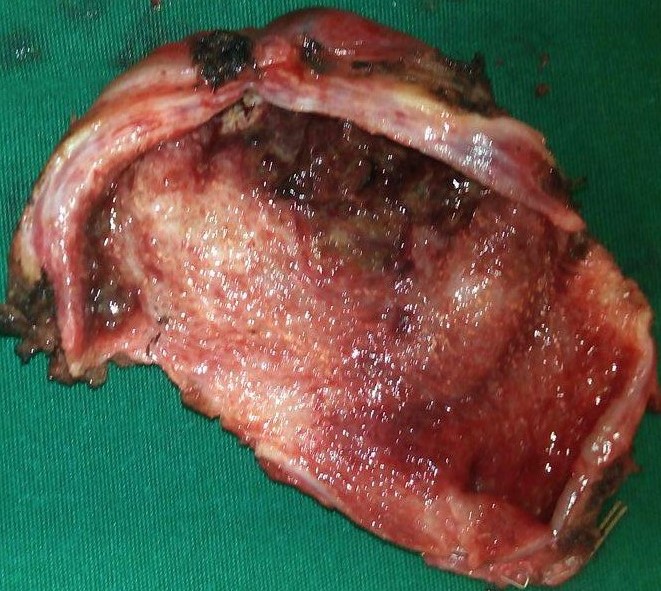 Hepatic abscess in a patient with cholecystocolic fistula and gallbladder empyema (Courtesy Dr. V. Penopoulos)