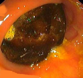 Hepatic abscess in a patient with cholecystocolic fistula and gallbladder empyema (Courtesy Dr. V. Penopoulos)