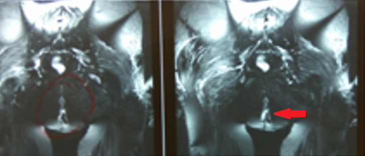 Προκτοσκόπηση — Τυφλίτιδα ανορθικής περιοχής (Ευγενική παραχώρηση Dr. V. Penopoulos)