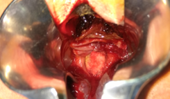 Μακροσκοπική άποψη μετά από χειρουργική εκτομή νεκρωτικού ιστού (Ευγενική παραχώρηση Dr. V. Penopoulos)