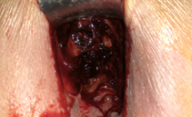 Παρασκεύασμα μίνι δεξιάς ημικολεκτομής — Είναι εμφανής νέκρωση και διάτρηση τυφλού (Ευγενική παραχώρηση Dr. V. Penopoulos)