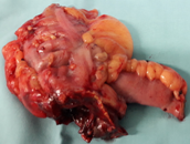 Εκκόλαση Meckel — Παρουσία έκτοπου γαστρικού βλεννογόνου (Ευγενική παραχώρηση Dr. V. Penopoulos)