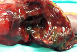 CT κοιλίας. Κόκκινο βέλος — Τυφλίτιδα. Σημαντική πάχυνση τοιχώματος τυφλού (Ευγενική παραχώρηση Dr. V. Penopoulos)