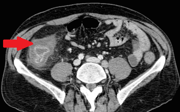 CT κοιλίας. Κόκκινο βέλος — Τυφλίτιδα. Σημαντική πάχυνση τοιχώματος τυφλού (Ευγενική παραχώρηση Dr. V. Penopoulos)