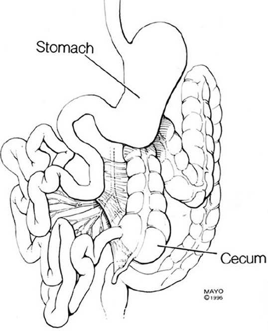 Left — Schematic representation of anomalous midgut rotation. Right — Macroscopic view after entering the abdomen. Purple arrow — Small bowel. Cyan arrow — Cecum (Courtesy Dr. V. Penopoulos)