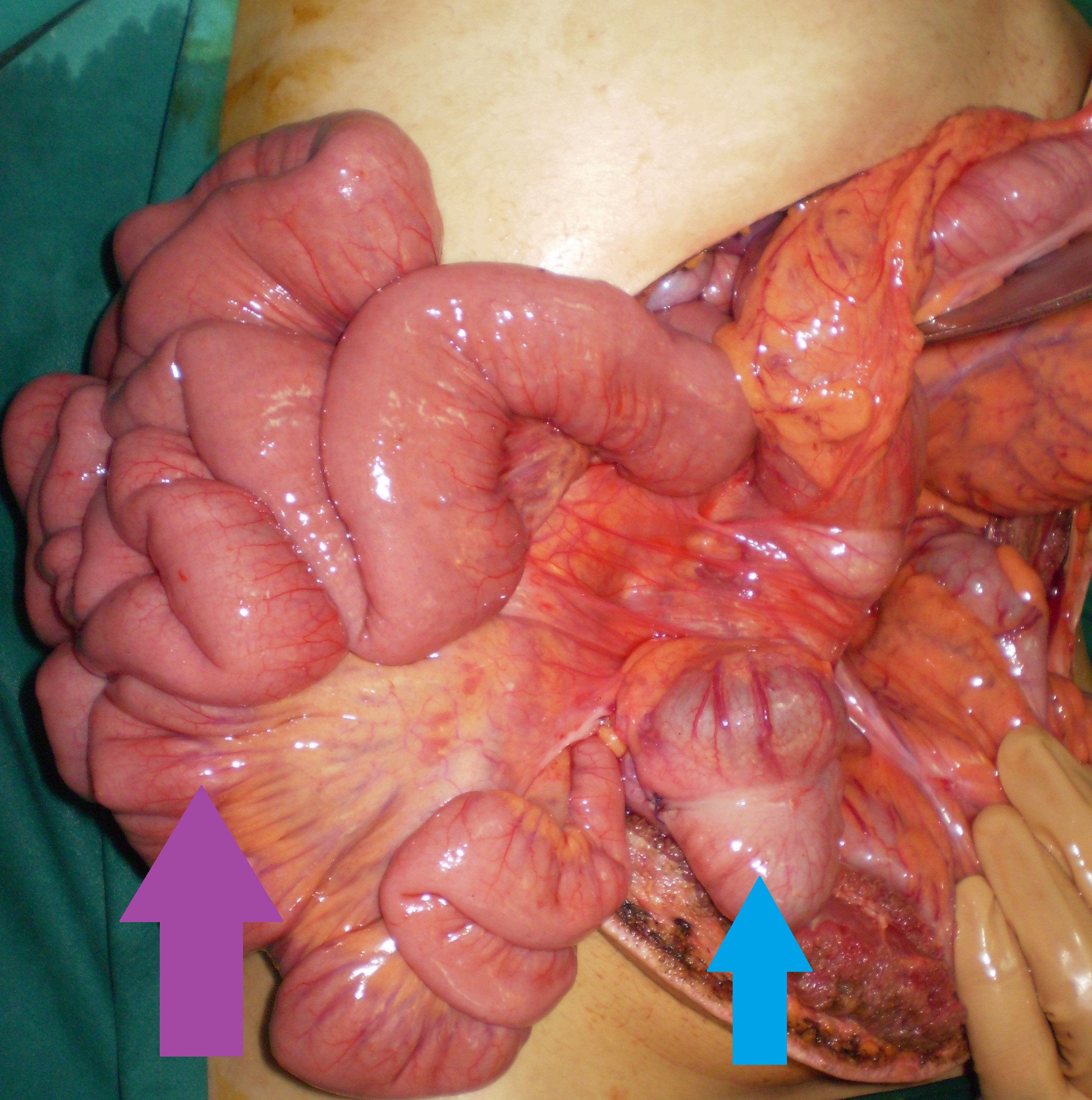 Left — Cecal volvulus and duodenal obstruction. Right — Complete reduction of cecal volvulus (Courtesy Dr. V. Penopoulos)