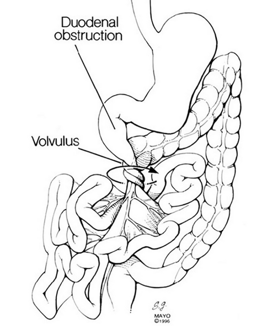 Division of Ladd's bands (Courtesy Dr. V. Penopoulos)