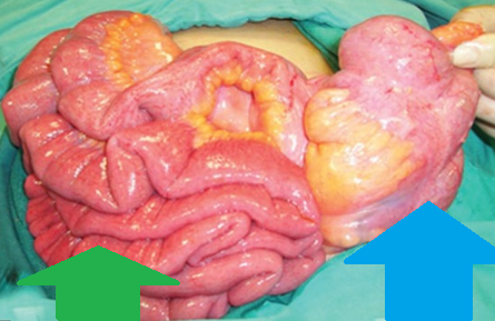 Barium swallow — Anomalous midgut rotation (Courtesy Dr. V. Penopoulos)