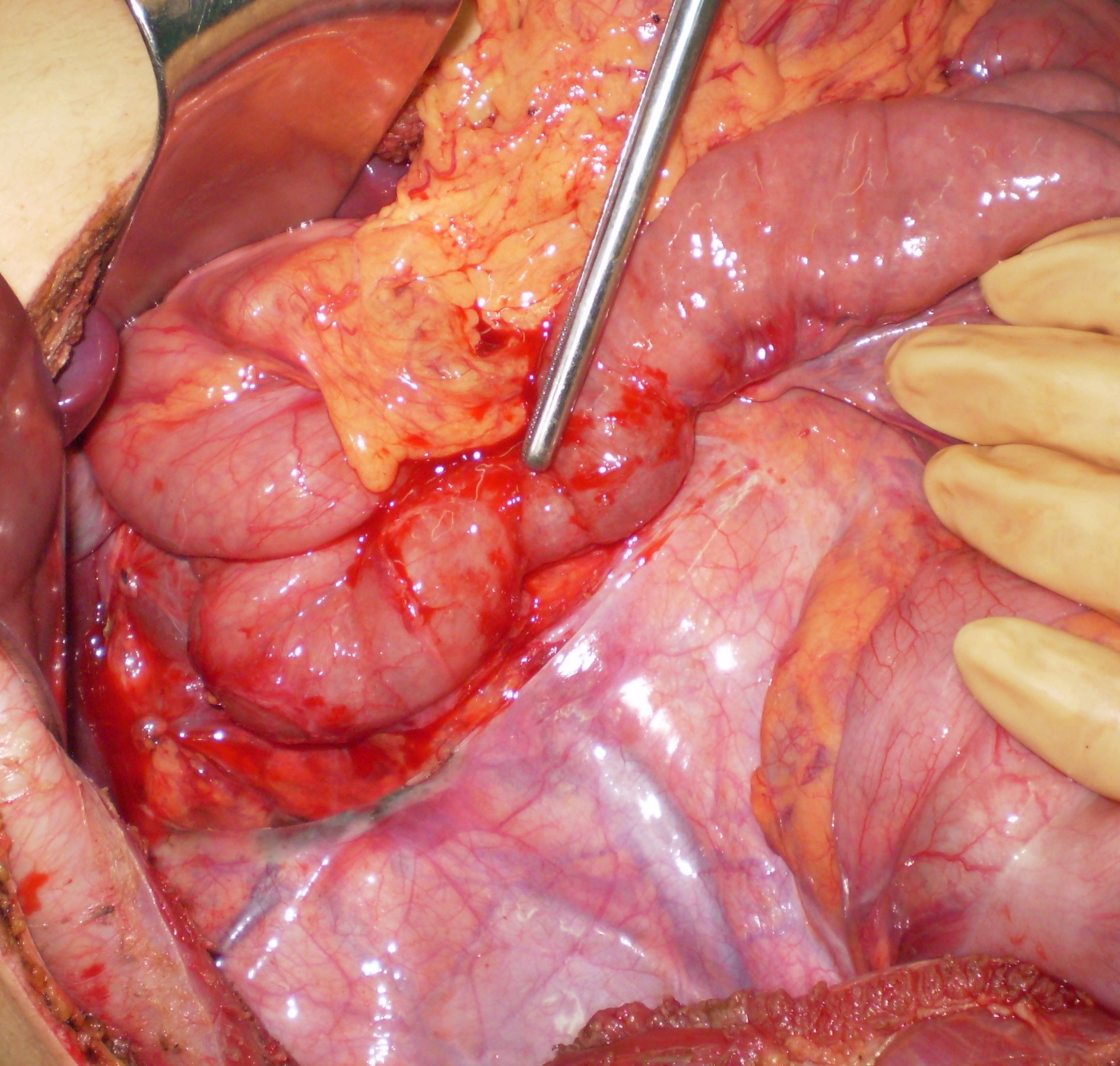 Barium swallow — Anomalous midgut rotation (Courtesy Dr. V. Penopoulos)