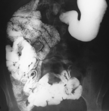 Barium swallow — Anomalous midgut rotation (Courtesy Dr. V. Penopoulos)