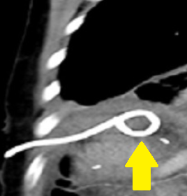Percutaneous biloma drainage (Courtesy Dr. V. Penopoulos)