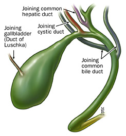 Patient CT, 6th postoperative day. Contrast in the gallbladder fossa. Red arrow — Injured Luschka duct (Courtesy Dr. V. Penopoulos)