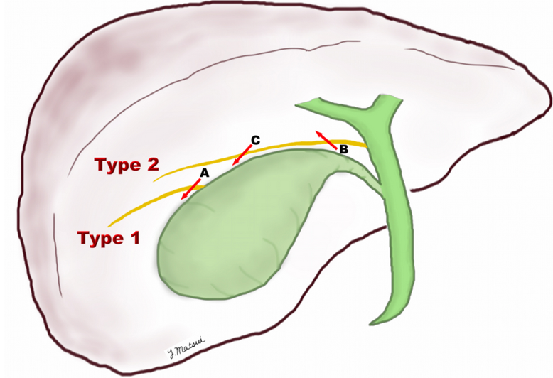 Patient CT, 6th postoperative day. Contrast in the gallbladder fossa. Red arrow — Injured Luschka duct (Courtesy Dr. V. Penopoulos)