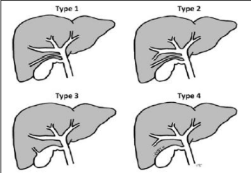 Yellow arrow — Contrast collection in the gallbladder fossa. Red arrow — Injured Luschka duct (Courtesy Dr. V. Penopoulos)