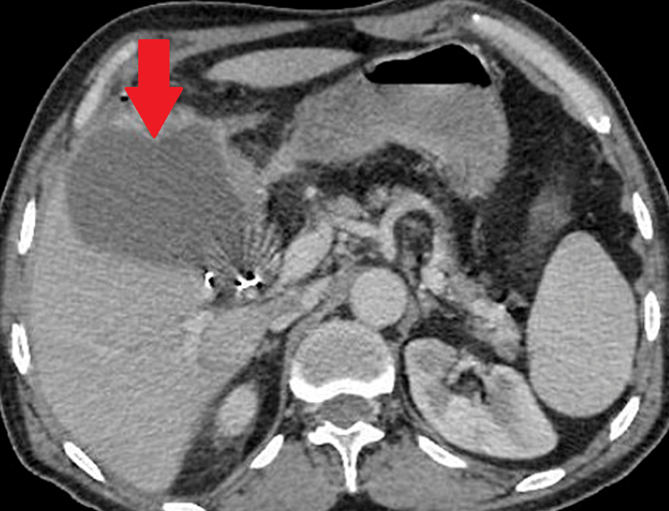 Cholangiography — Red arrow. Injured Luschka duct (Courtesy Dr. V. Penopoulos)
