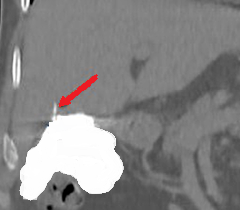 Percutaneous biloma drainage (Courtesy Dr. V. Penopoulos)