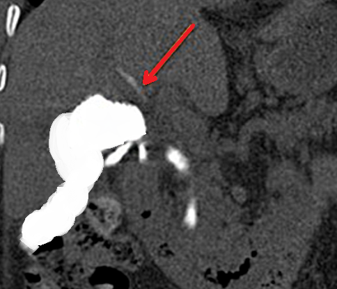 Percutaneous biloma drainage (Courtesy Dr. V. Penopoulos)